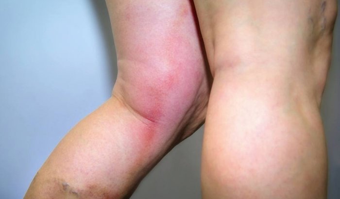 Ajuda para o tratamento de trombose 