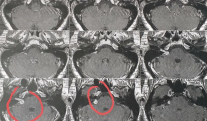 Camilla (descobri um NEURINOMA)