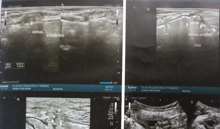Cirurgias,hérnias