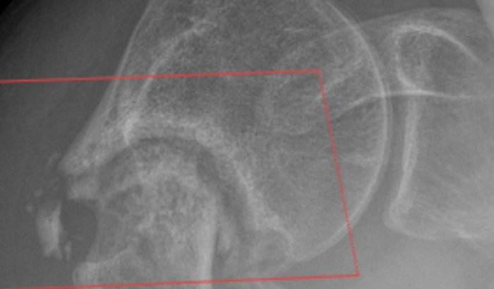 Cirurgia Úmero Superior / Não Contemplada pelo SUS
