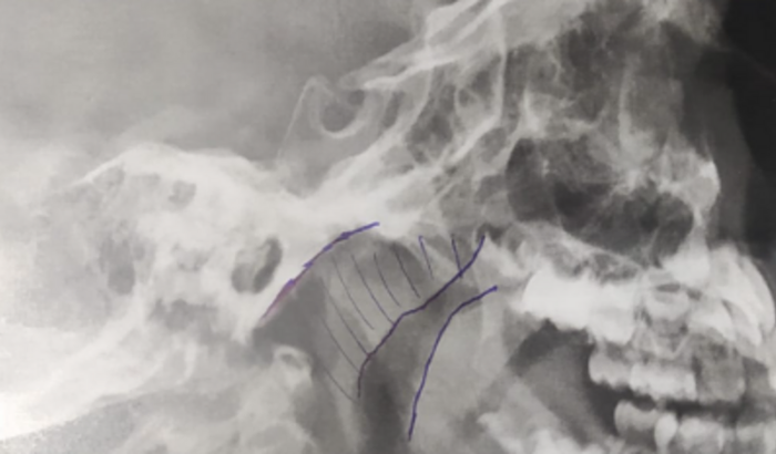 Cirurgia de Adenoide para criança de 4 anos.