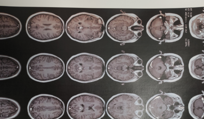 AJUDE A PAGAR TRATAMENTO - Tumor Hipófise