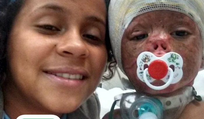 AJUDA URGENTE PARA JOÃO QUE SOBREVIVEU A UM INCÊNDIO   