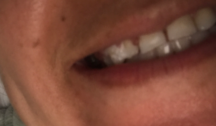 Ajudar para me colocar um dente meu que quebrou não tenho condições de colocar estou com um provisório