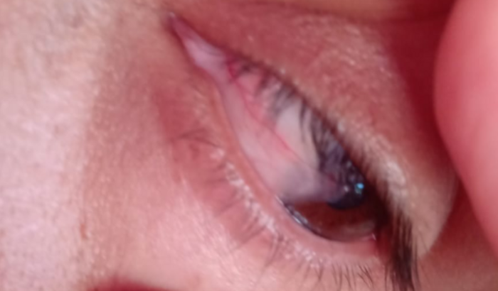 Ajuda para cirurgia dos olhos 