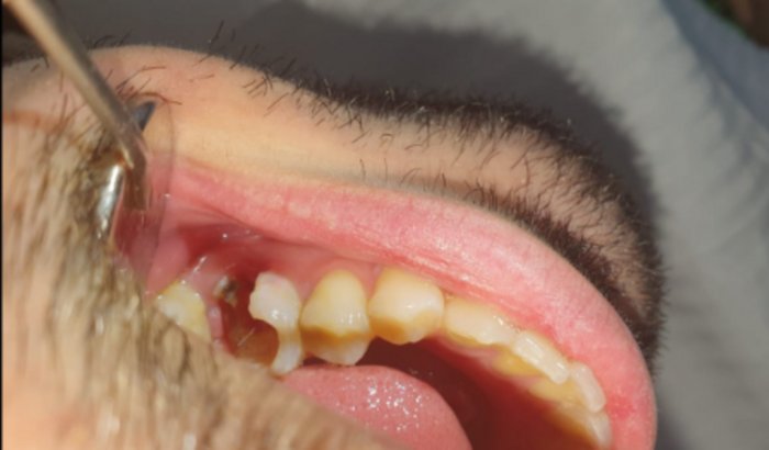 Extração e implante dentário