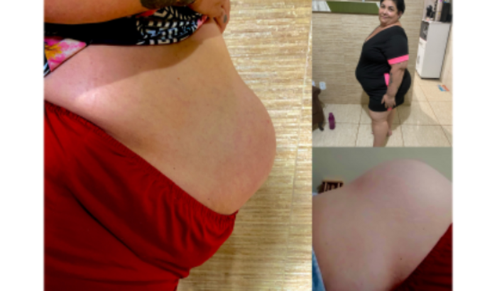 Cirurgia hérnia e bariátrica 