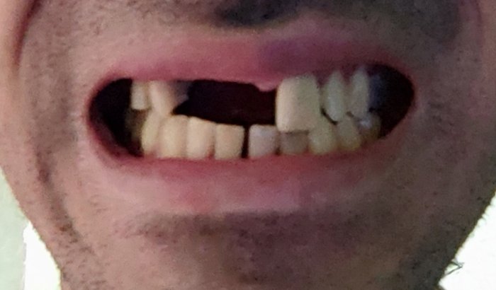 Tratamento Dentário - Implante 