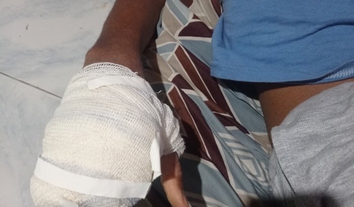 Prótese para o Binho 