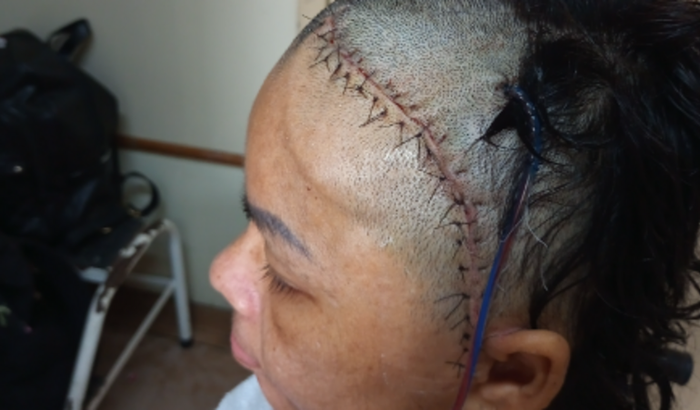 Recuperando de uma cirurgia de aneurisma