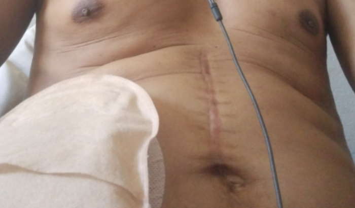 Tratamento de câncer retal