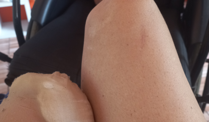 PRÓTESE  ! ME AJUDEM A VOLTAR  a  ANDAR