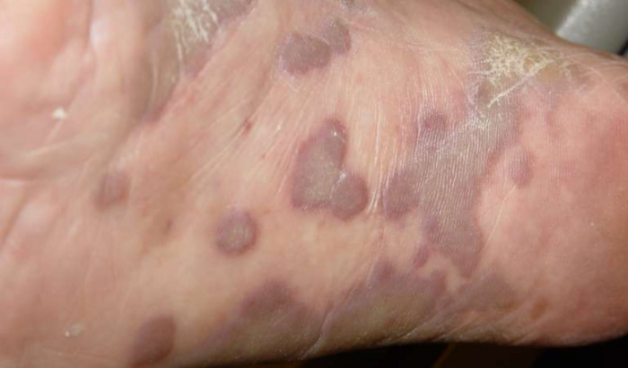 Custos pós cirúrgico tratamento de câncer.