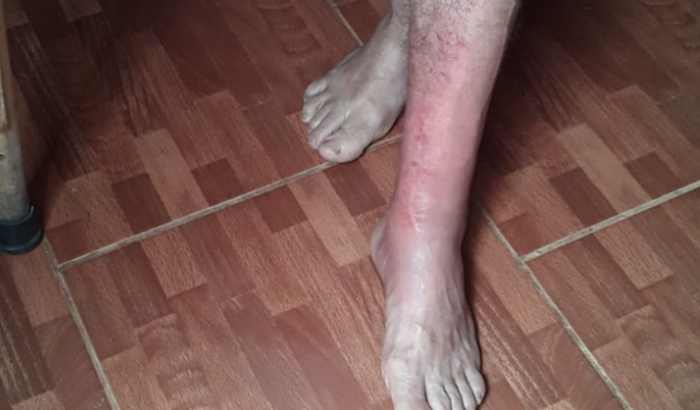 Meu pai quebrou o pé e está sem trabalho