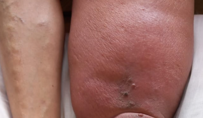 Tratamento de Linfedema