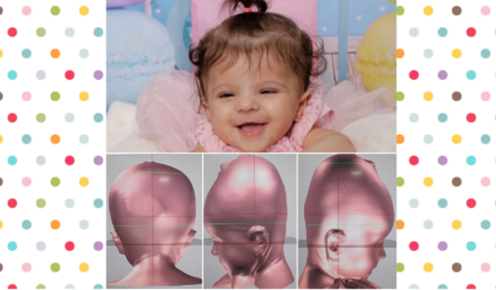 Ajuda Para Pagar Tratamento de Órtese Craniana (capacetinho) da Helena (Minha sobrinha)