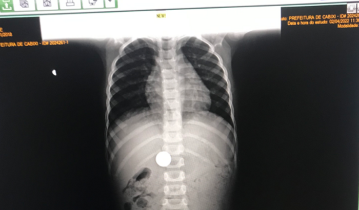 Cirurgia de Pedro Henrique silva murari 