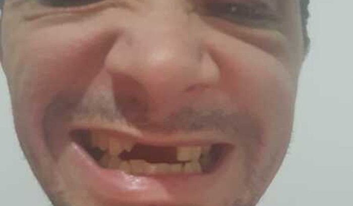 Ajuda para fazer Implante dos Dentes & Fazer o Óculos 