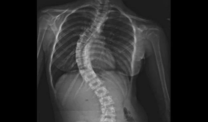 Cirurgia da Duda ( Escoliose ) 