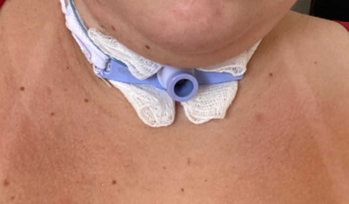 Em prol a cirurgia de estenose de traqueia da Lorrainy 