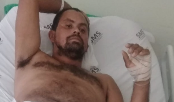 Para compra prótese para perna