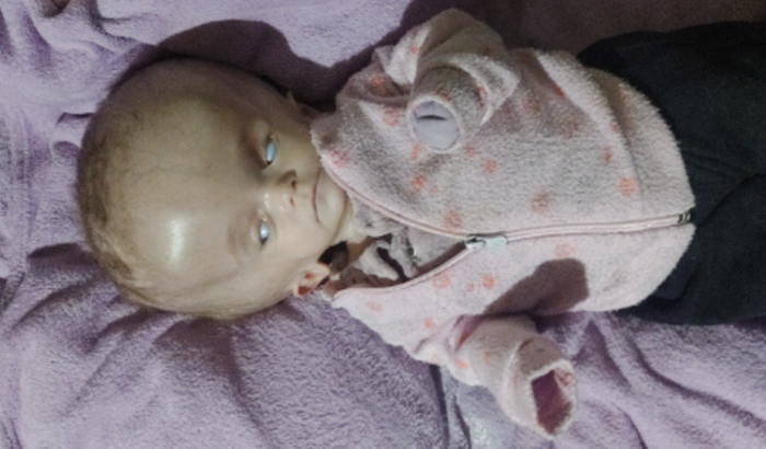 Tratamento neuroendoscopia flexível para Maitê stefani que tem hidrocefalia 