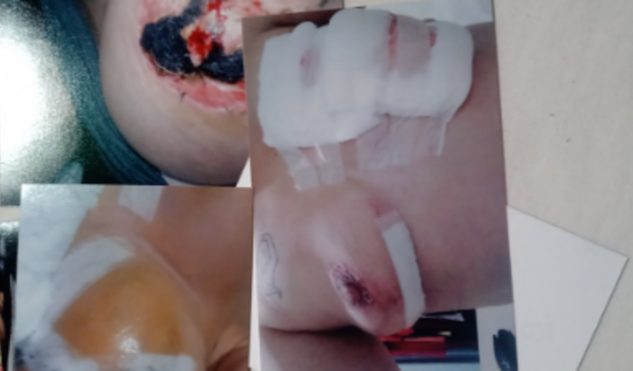 Colocação da mama direta onde tive 98%da mama perdida