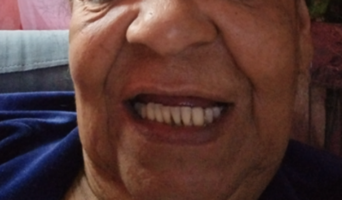 Ajuda pela prótese dentária fixa 