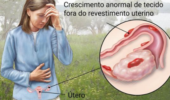 Cirurgia de Endometriose