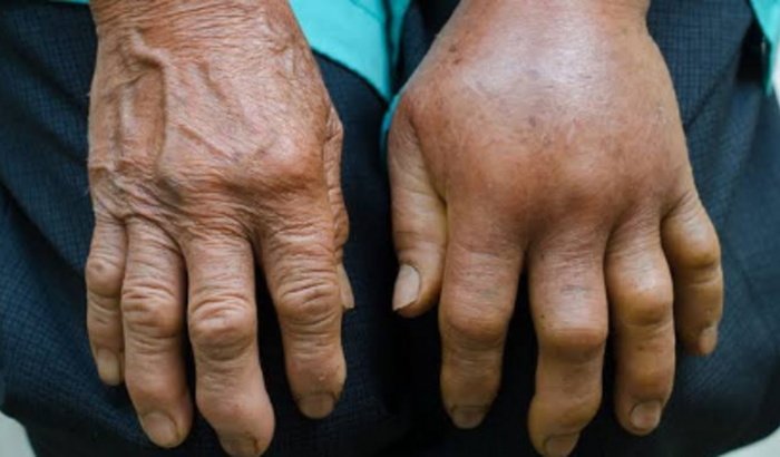 CIRURGIA TÚNEL DO CARPO (NA MÃO)