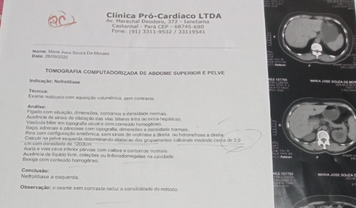 Cirurgia de pedra no rim (minha mãe)