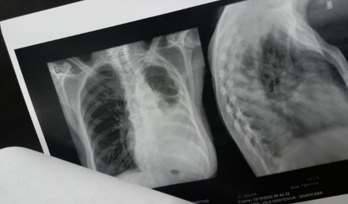 Tratamento de câncer da minha tia 