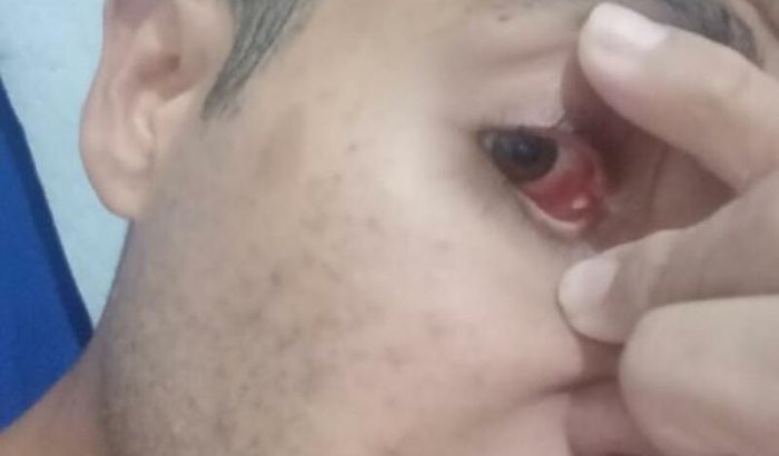 TRÊS CIRURGIAS DE VISTA CISTO CONJUNTIVAL MIOPIA E ASTIGMATISMO 