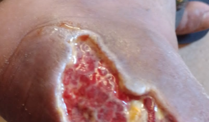 Tratamento Urjente "Levir"