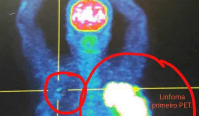 Ajude a Márcia nos Exames e Cirurgia de Retirada de Linfomas