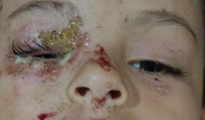 Ajuda no tratamento de celulite periorbitaria e dermatite atópica de Samuel Falcão 