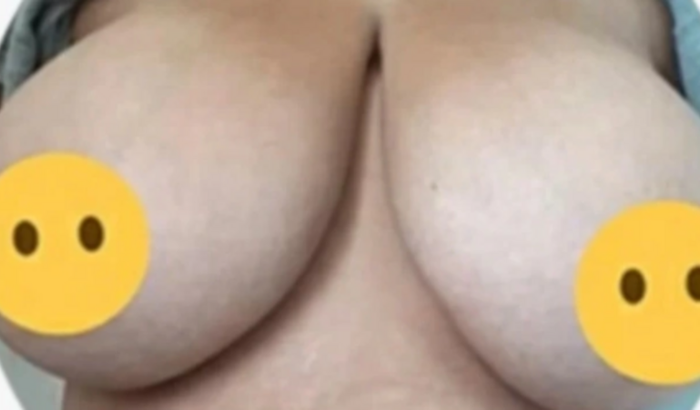 Ajuda para Minha cirúrgia de Reduçao Mamária