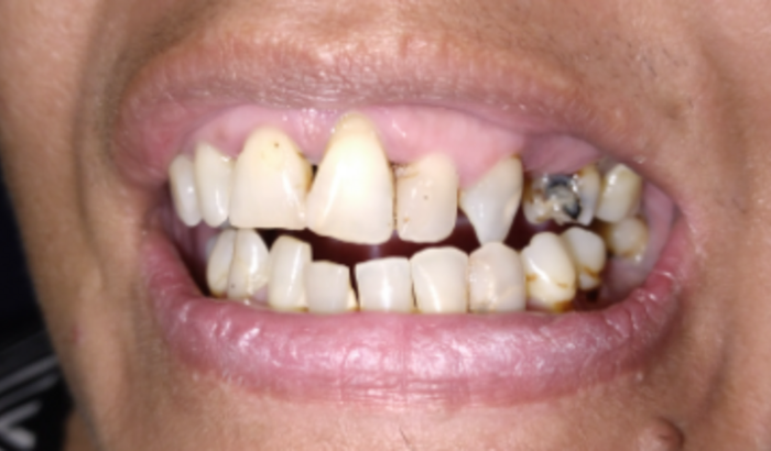 Tratamento bucal da minha Mãe. Por favor, preciso ver ela sorrir de novo