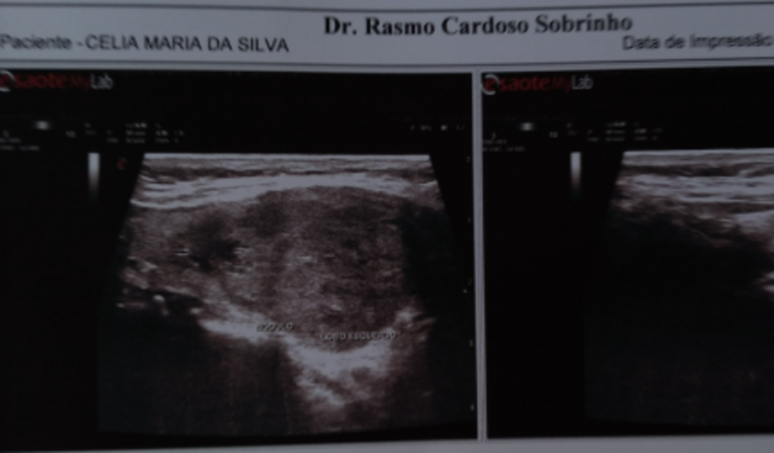 Cirurgia de tireoidectomia