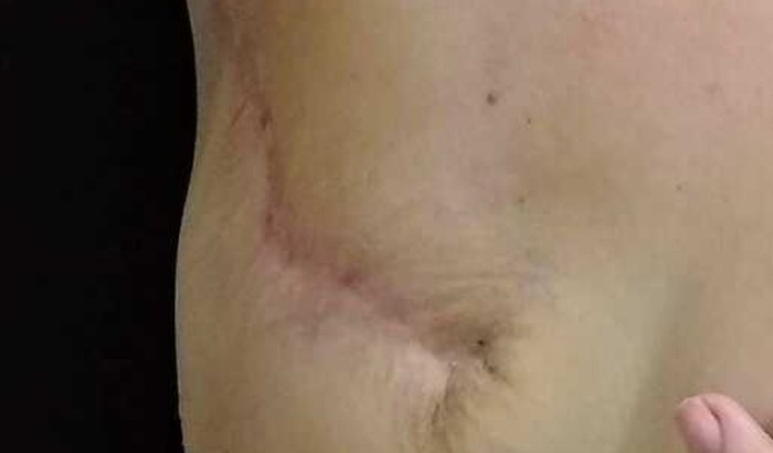 Ajuda para fazer cirurgia de reconstrução mamária