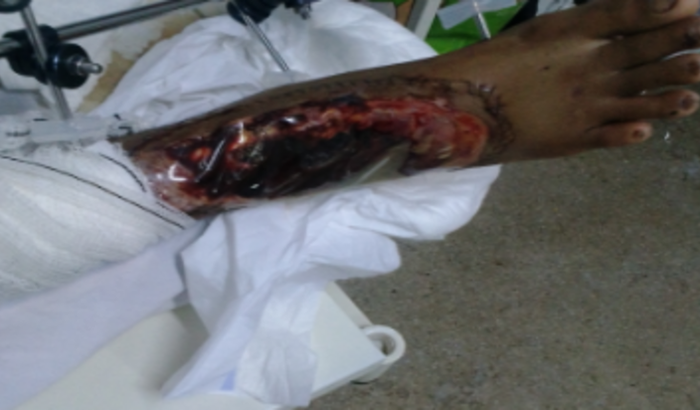 Tratamento do meu tornozelo. Devido a perca de ligamentos e necessário várias sessões de fisioterapia e medicamentos