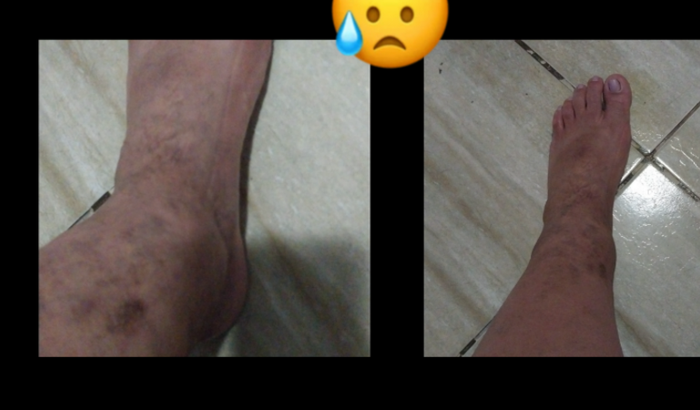 Problema venoso (dificuldade de retorno)