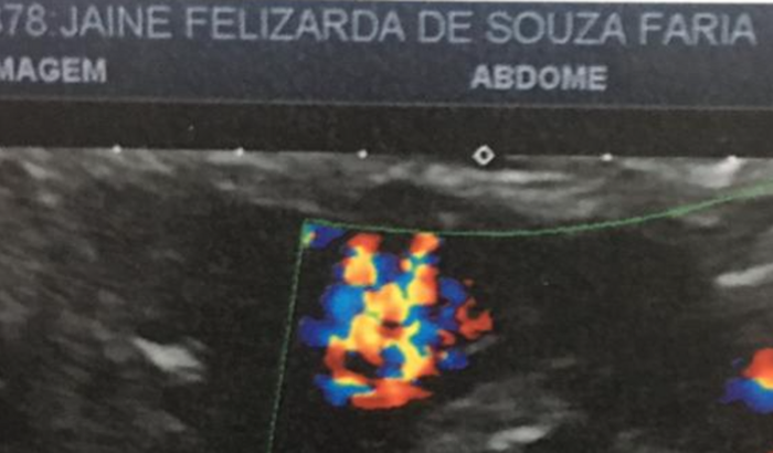 Cirurgia de Cancer na Bexiga