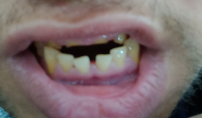 Ajuda para cirurgia na arcada dentária