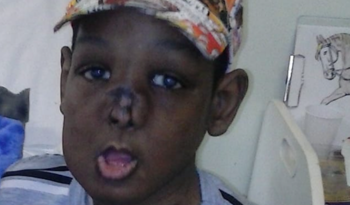 Uma esperança para Alex - Ajuda para operação de reconstrução