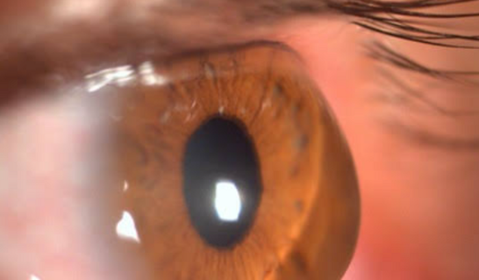 Tratamento ceratocone (consultas + lentes)