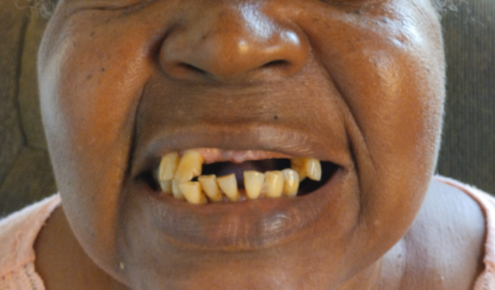 Ajuda para colocar dentes