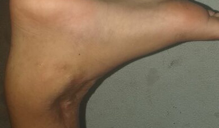 Para a compra de uma cadeira de rodas .