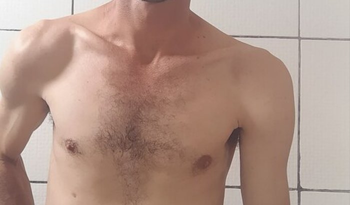 Cirurgia de Reversão colostomia e ileostomia