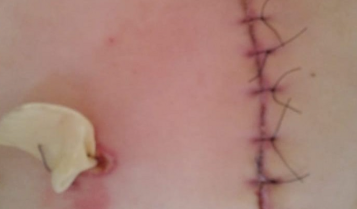 ajuda financeira de recuperação de cirurgia 